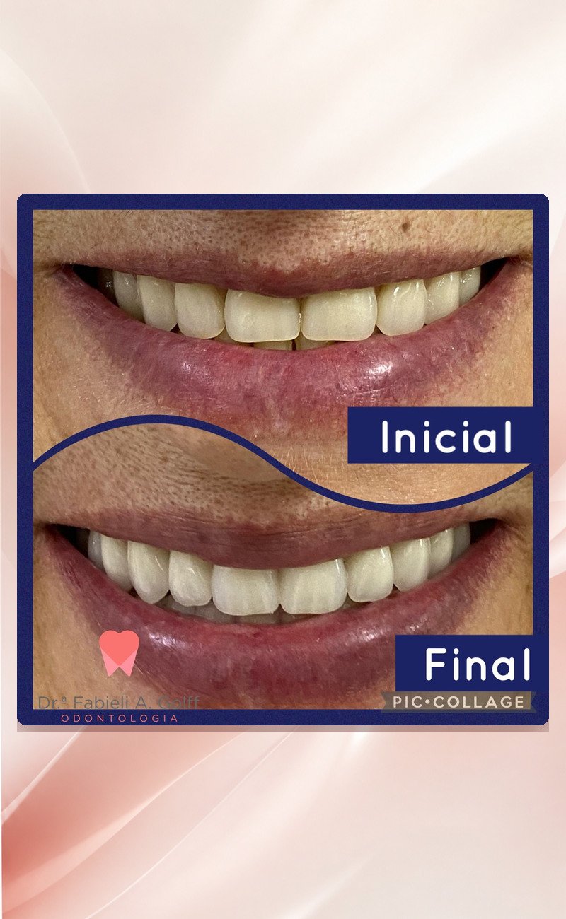 03-antes-e-depois-sorriso