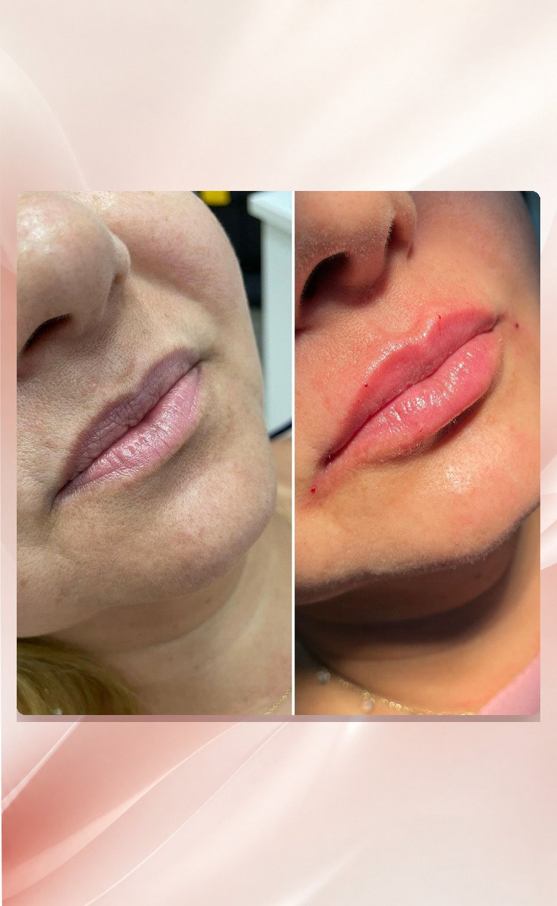 04-preenchimento-labial