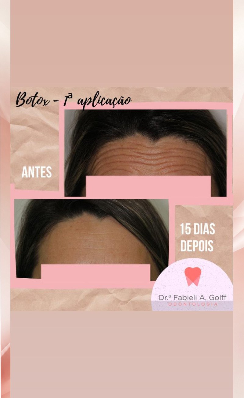 08-botox-primeira-aplicacao
